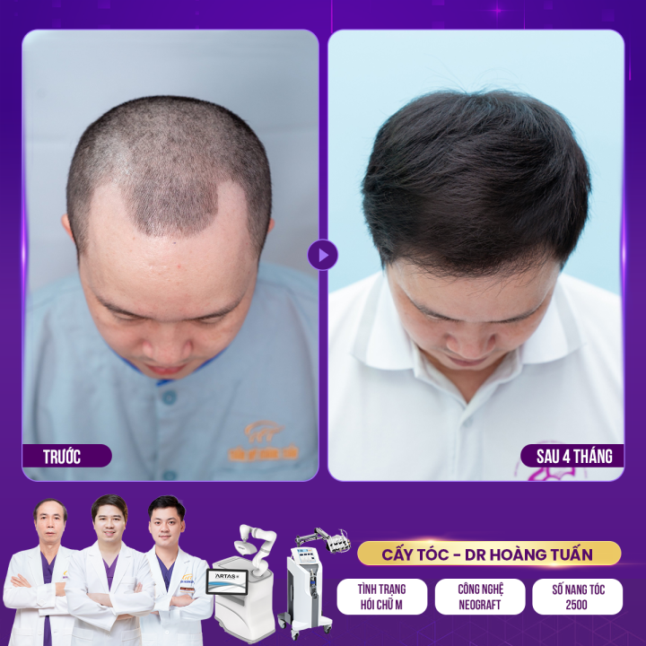 Cấy tóc hói chữ M